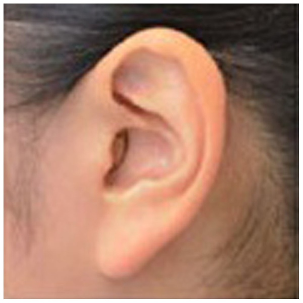 デジタル補聴器】【店舗限定販売】Insio 3BX CIC（耳あな型）オーダー